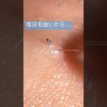 毛を抜いただけなのに