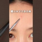 【膿ニキビを数日で枯らす方法！】 #ニキビ #ニキビケア #ニキビケア対策 #ニキビ肌